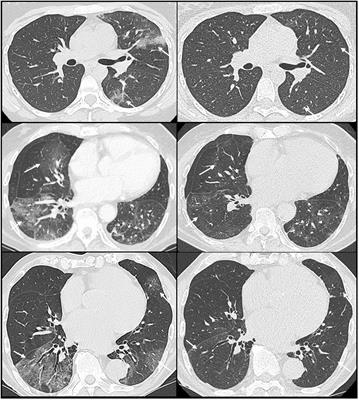 Intravenous immunoglobulins for the treatment of prolonged COVID-19 in immunocompromised patients: a brief report